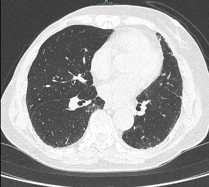 CT検査 肺野（HRCT）