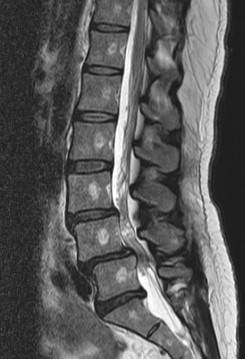 MRI検査 腰椎（矢状断）