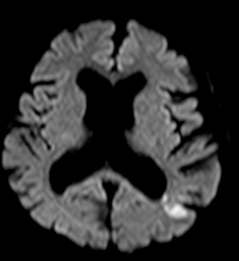 MRI検査 急性期脳梗塞
